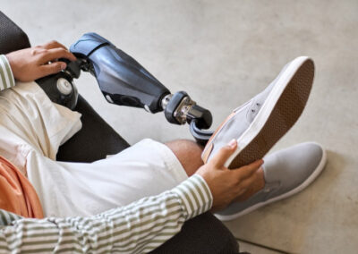 Osoba s protézou nohy sedí na židli, má na sobě světlé šortky a pruhované tričko, drží tenisku a chystá se ji nasadit na protézu.